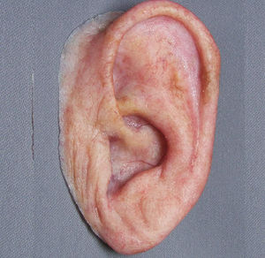 prótesis estética esterna auricular