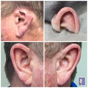 prótesis estética esterna auricular 1
