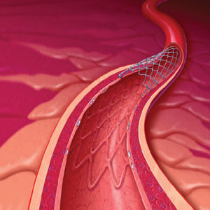 stent arteria coronaria 1