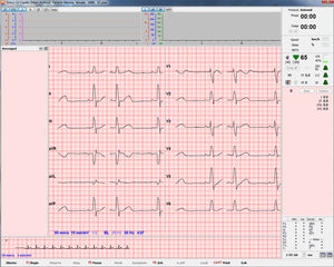 módulo de software para ECG