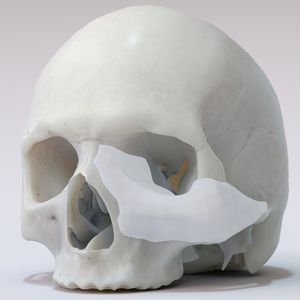 implante periorbital a medida 1