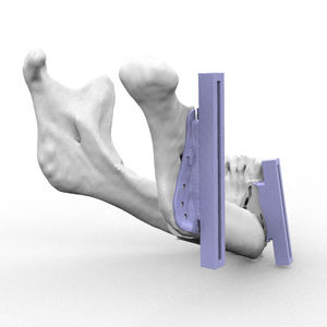 plantilla de resección para la reconstrucción maxilofacial 1