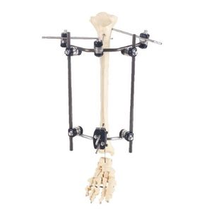 fijador externo para tibia