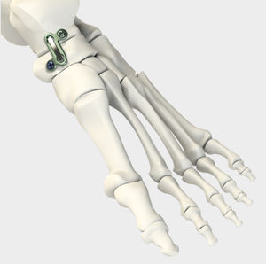 placa de artrodesis para articulación talonavicular 1