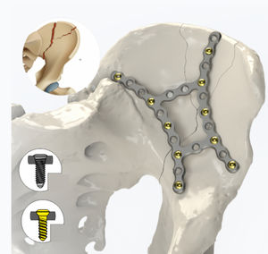 placa de compresión para pelvis 1