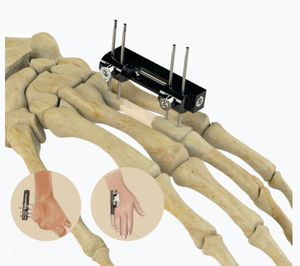 fijador externo para articulación metacarpofalángica 1