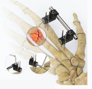 fijador externo para articulación metatarsofalángica 1