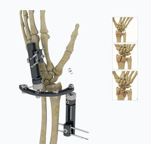 fijador externo para muñeca 1