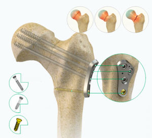 placa de compresión para cabeza femoral