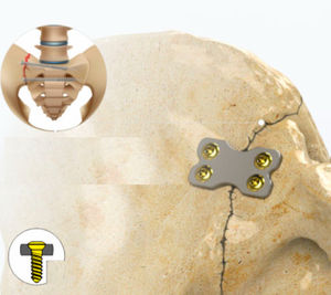 placa de compresión para articulación sacroilíaca 1
