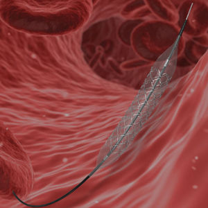 stent arteria coronaria