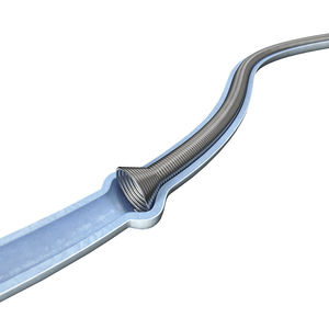 stent ureteral 1