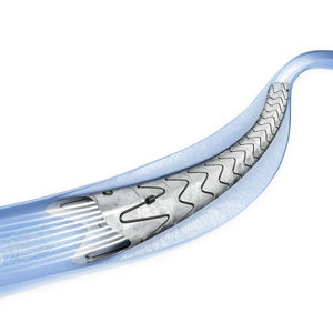 stent ureteral 1