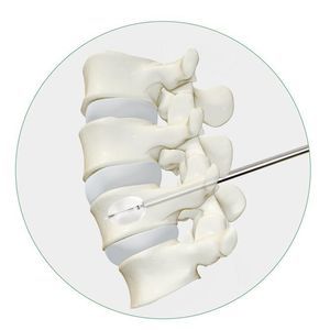 sistema de aumento vertebral globo