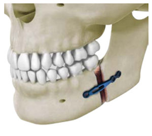 placa de osteotomía para mandíbula