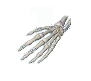 tornillo de compresión ósea para metacarpo