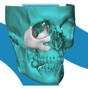 implante periorbital a medida