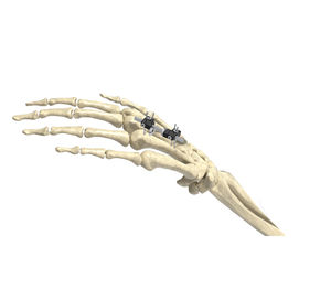 fijador externo para articulación metacarpofalángica