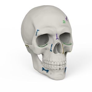 sistema de fijación craneal no reabsorbible 1