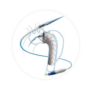 stent-injerto aorta torácica ascendente