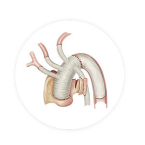 stent-injerto arco aórtico