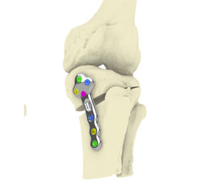 placa de osteotomía para tibia