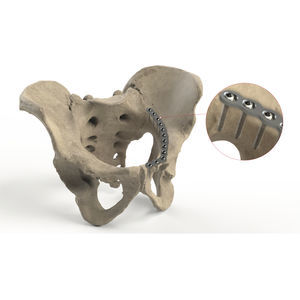placa de compresión pelvis 1