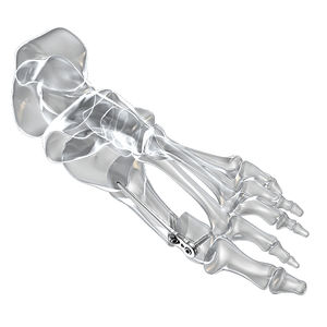 placa de osteotomía para hallux valgus