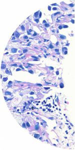 kit de prueba de cáncer de pulmón