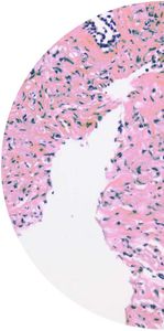 kit de prueba de cáncer de próstata