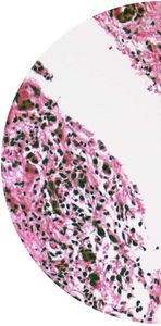 kit de prueba de glioma