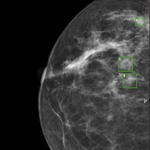software para detección del cáncer de mama