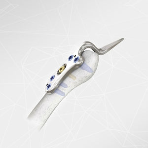 placa de compresión articulación acromioclavicular 1