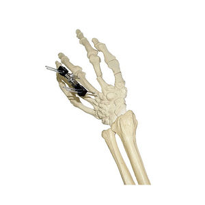 fijador externo para articulación metacarpofalángica 1