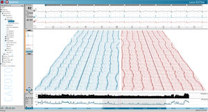software para Holter cardíaco