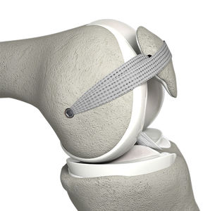 prótesis de ligamento ligamento femoropatelar 1