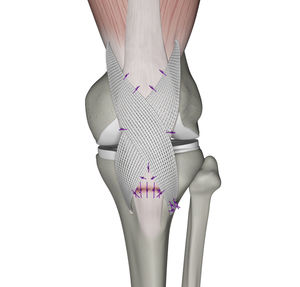 prótesis de ligamento tendón cuadricipital 1