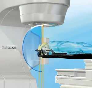 acelerador lineal de particulas radiocirugía estereotáxica