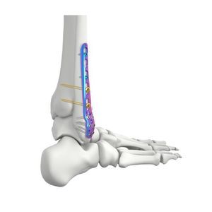 placa de osteotomía para peroné 1
