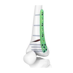 placa de osteotomía para fémur 1