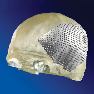 implante craneal