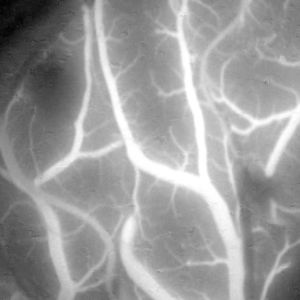 cámara de vídeo para microscopio operatorio