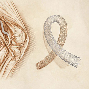stent periférico