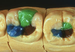 material dental cera