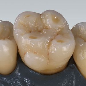 material dental de circona