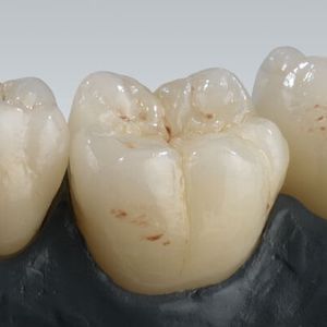 material dental de cerámica / para corona / altamente translúcido