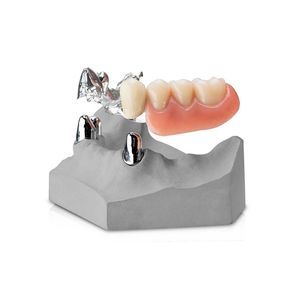 prótesis dental de cromo cobalto 1