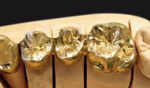 material dental de metal