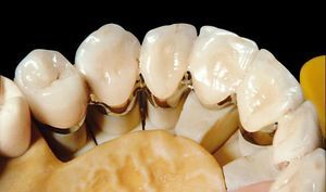 material dental de metal