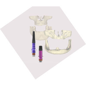 implante dental cilíndrico